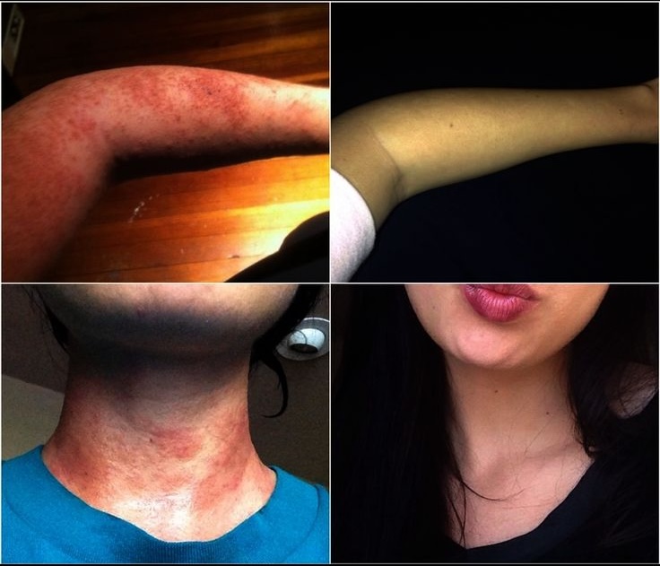 Person with skin rashes due to mold exposure